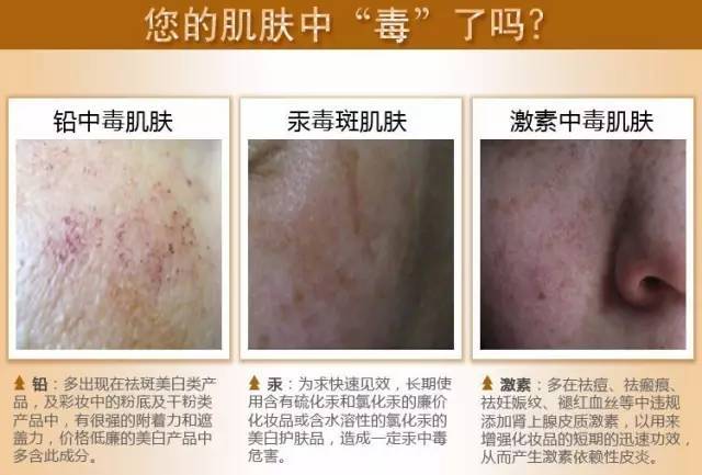 【郑一生国际】远离"斑中之癌",杜绝"铅汞中毒斑"!