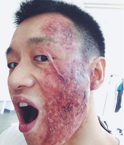 佟大为晒毁容造型吓坏网友皮肤溃烂满脸血疤丑哭了
