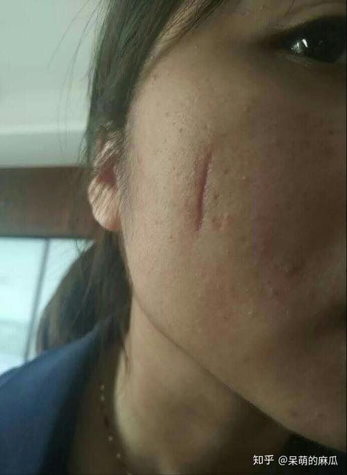 怎么淡化缝针后的疤痕?