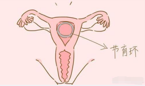 什么情况下应该取环?