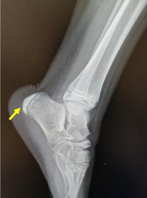 患儿,男,11岁,跟骨骨骺炎,跟骨侧位片可见跟骨骨