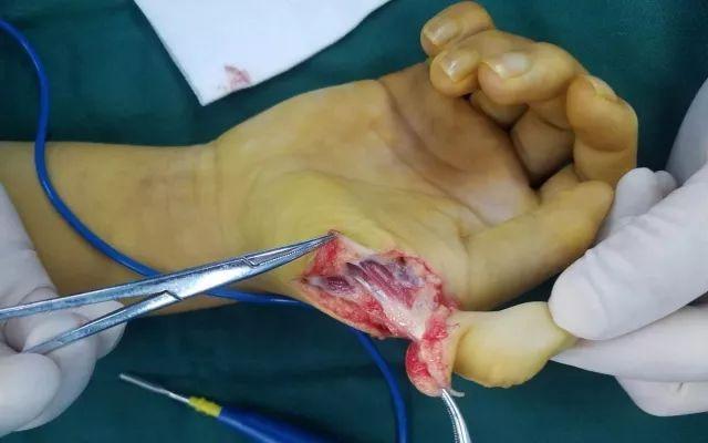 屈和拇短展肌术中截骨术后"小六指"治疗要及时多指畸形的手术治疗时机