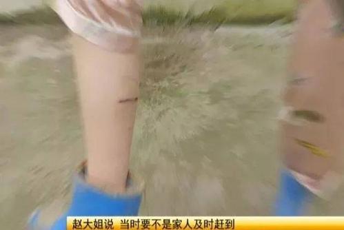 安徽一地恶狗连伤5人,女子被咬后,忍痛将狗掐死!