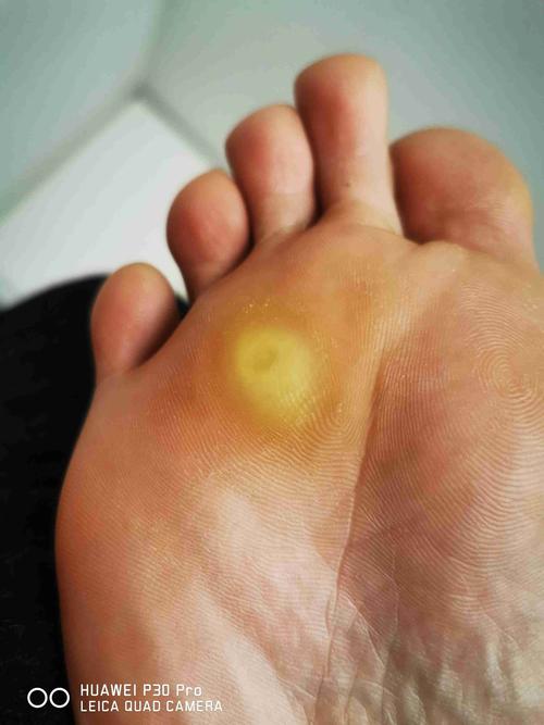 会被疼醒,看过好多次都没治好,说法不一分别是脚垫,鸡眼,血包肉刺