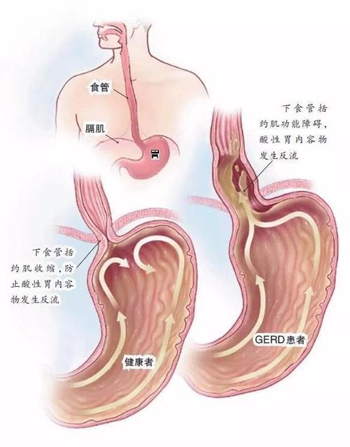 反复咽炎,可能是胃食管反流在捣乱