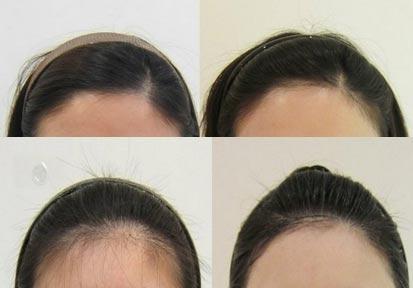 激光发际线脱毛的原理是什么