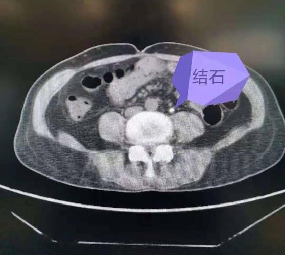 案例故事 | 嵌顿结石堵死输尿管"腰痛积水",顺行软镜钬激光发威"水落