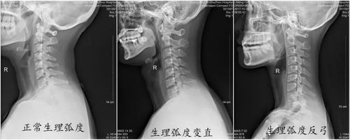为什么颈椎生理曲度会变直?会有什么严重后果吗?