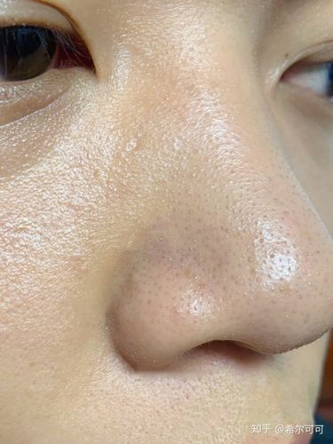 黑头脸部毛周角化毛孔!