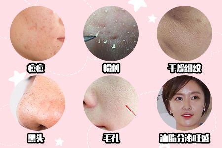 做好小气泡,轻松解决痘痘,黑头粉刺问题