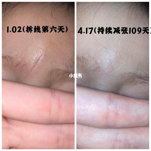 缝合5针,无痕近在眼前!_宝宝额头受伤缝针_母婴_育儿