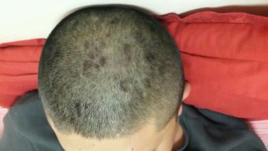 男性头上有脂溢性皮炎怎么办