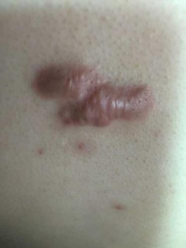 胸口一个硬疙瘩 胸口毛囊炎