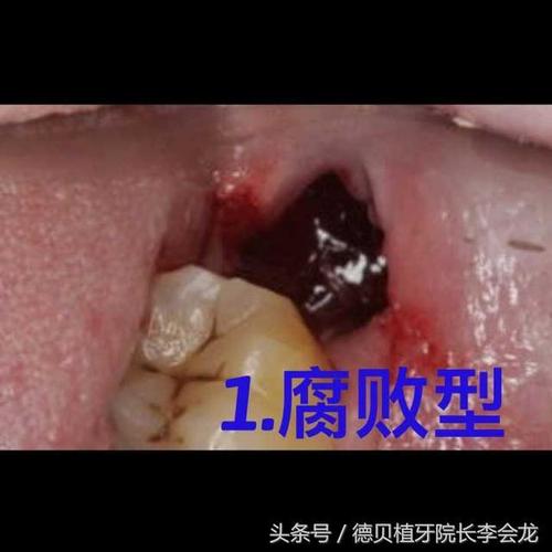 拔完智齿后怎么知道 是否出现干槽症和流脓?