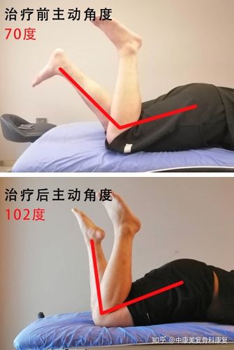 术后3个月角度才70度,一句话点醒了他.|膝关节案例