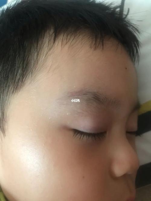 眉毛磕到没缝针_眉毛_疤痕_儿童磕伤疤痕_母婴_育儿