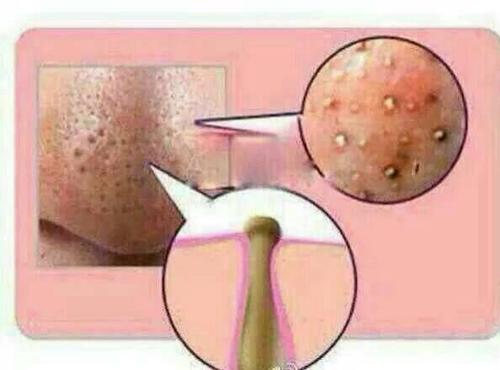 这张图片的黑头好吓人啊,友友们,你们的皮肤有这样的吗?