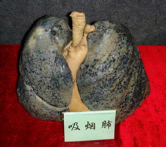 戒烟就是保命|肺癌|吸烟|烟龄_网易订阅