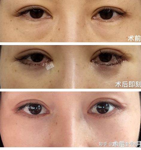 祛眼袋内切好还是外切好