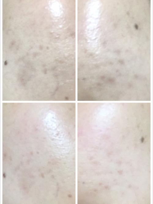 10天去痘印效果实测(带图)