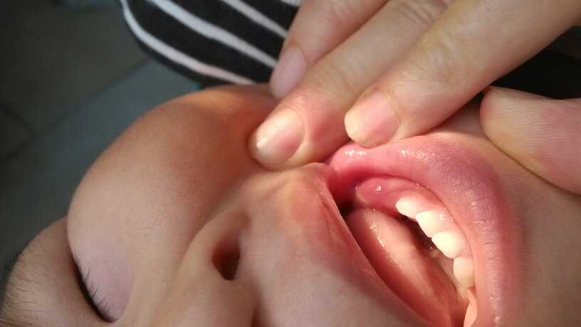 有谁知道宝宝牙龈这样是什么吗?急