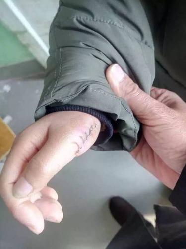 这一次,他们一个刚拆线,一个还绑着石膏,手术成功,而两个孩子五年的"