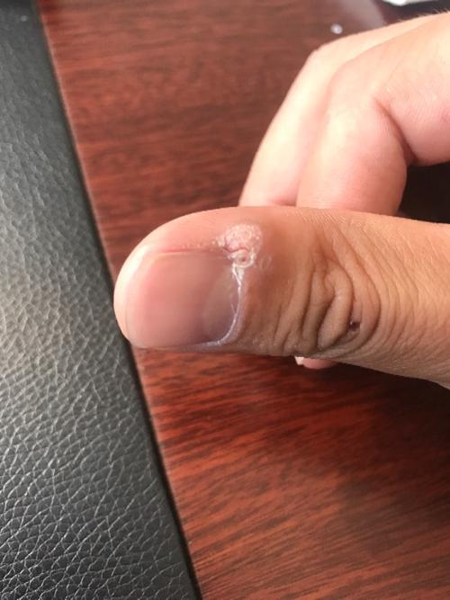 手指硬皮,大拇指角长硬皮