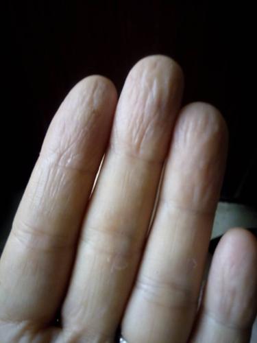 手指肚的皮肤蜕皮严重,而且就像老人的手一样干瘪满是皱纹