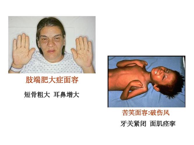 体格检查一般检查(概论) 肢端肥大症面容 短骨粗大 耳鼻增大 苦笑面容