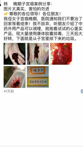 其它 宫颈癌病历  下图是山东泰安赵梓琛,宫颈癌和直肠癌晚期 1 例假