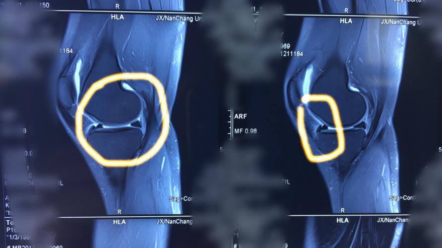 磁共振矢状面显示:内侧半月板前角撕裂.