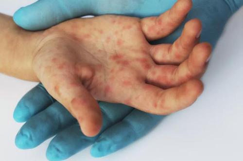 这些哄娃神器也能感染手足口病看看你家孩子在用吗