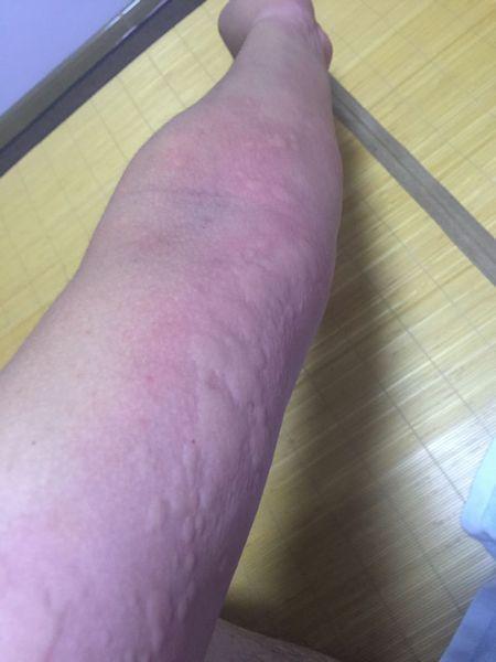 最近几个月每当到晚上回到家,或者是喝酒后身上就会出扁疙瘩,一片一片