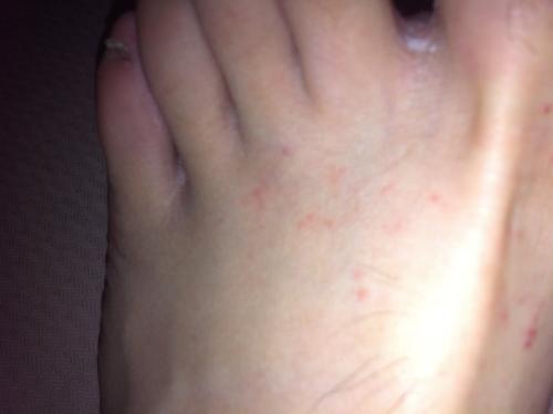 我脚上长这些 会是艾滋皮疹嘛 ?有过高危 5周阴