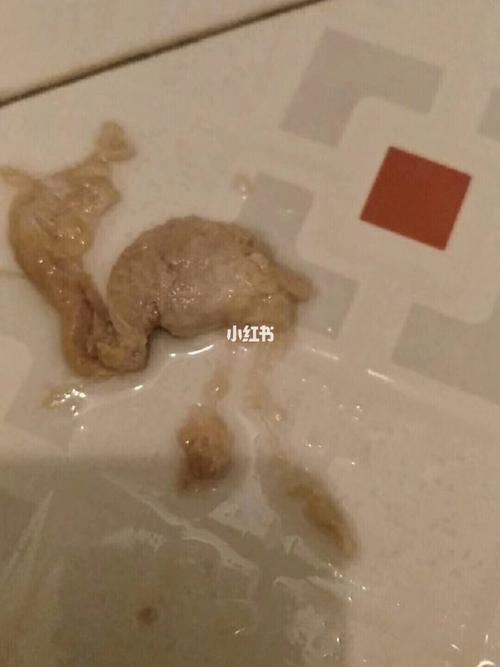 看这是糜烂三度的排出来的垃圾.姨妈残留,生孩子残留