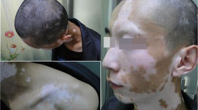 在村医务所看时,大夫说是像桃花癣,涂点药膏就好了,半个月过去了,白斑