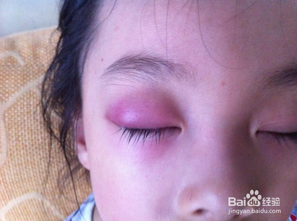孩子上眼皮红肿怎么办