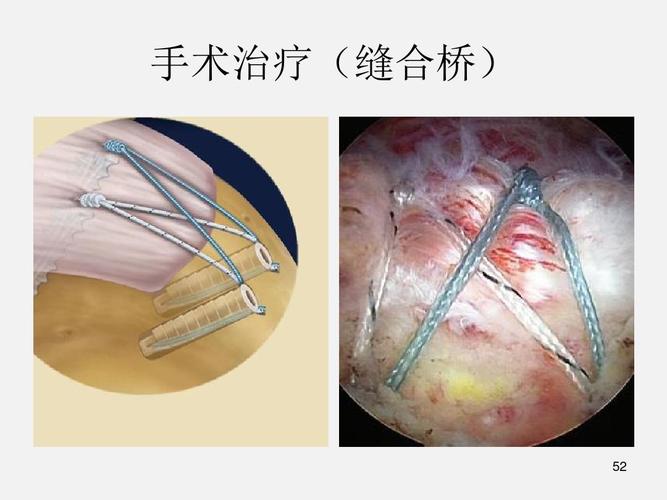 肩关节肩袖损伤的临床诊断及相关治疗