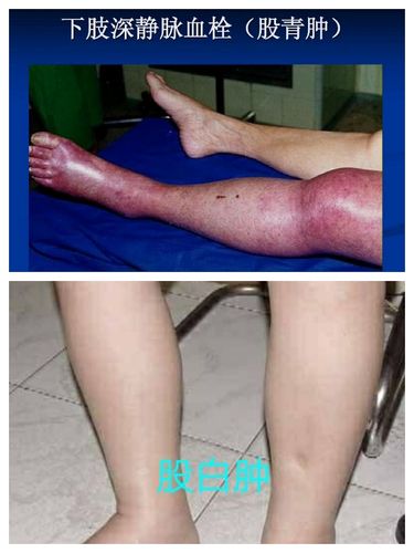 下肢深静脉血栓出入院宣教