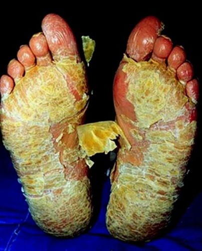脚气病脚底严重脚底脱皮图片