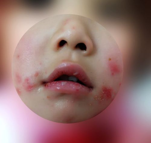 脓疱疮诊断治疗一种儿童好发的皮肤病