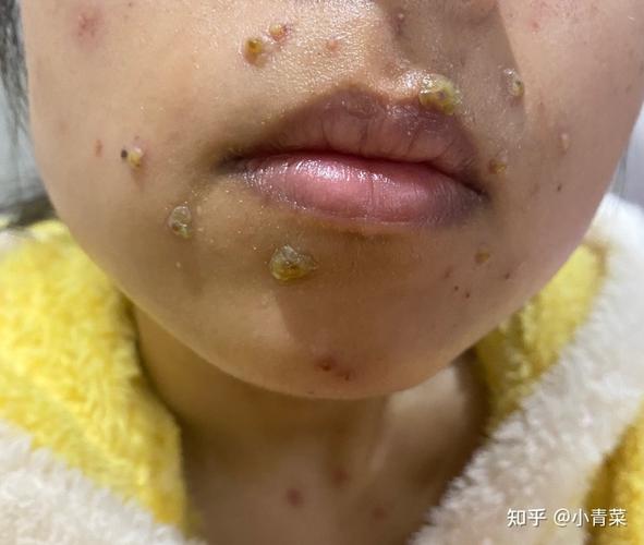 记录30岁老阿姨的水痘过程