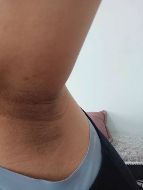 有没有孕妈怀孕胳肢窝变的黑黑的那种,有什么办法去掉嘛