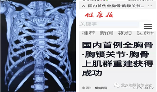   ●胸骨恶性肿瘤全胸骨切除,胸锁关节.