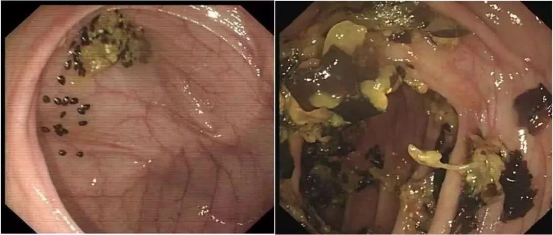 肠镜,肠道,内镜,泻药