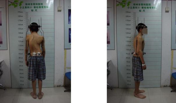 聋哑"月亮男孩儿"的心声——又一例极重度脊柱侧弯获成功救治
