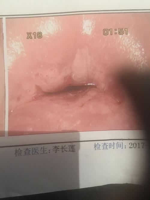 完整的鳞柱交界不可见,酷酸白色上皮,这是癌前病变吗?