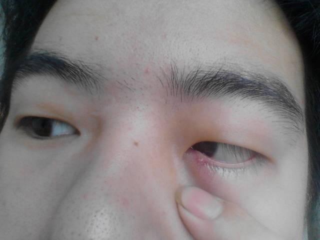 刚开始去药店人家说是麦粒肿,拿了眼药水一个星期不到就好了,过了几个