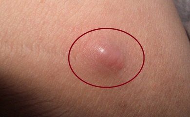 皮脂腺囊肿怎么治好呢