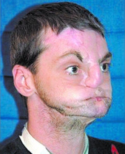 男子面目全毁 换脸工程创世界之最(图)